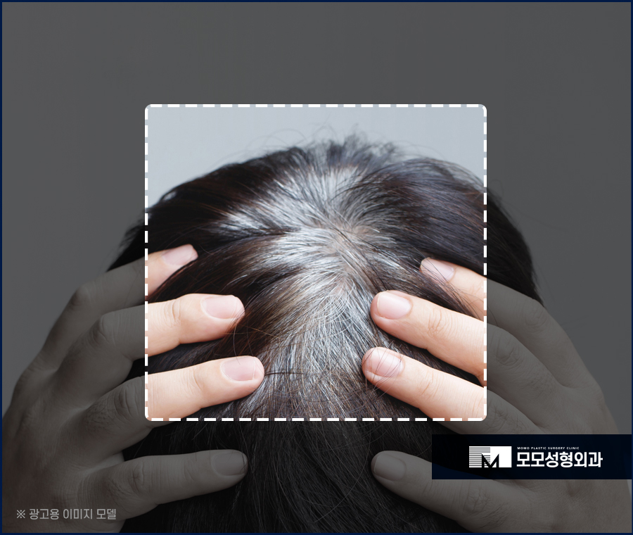 흰머리 간지러움 발생 요인부터 극복을 위해서는 관련 이미지 5