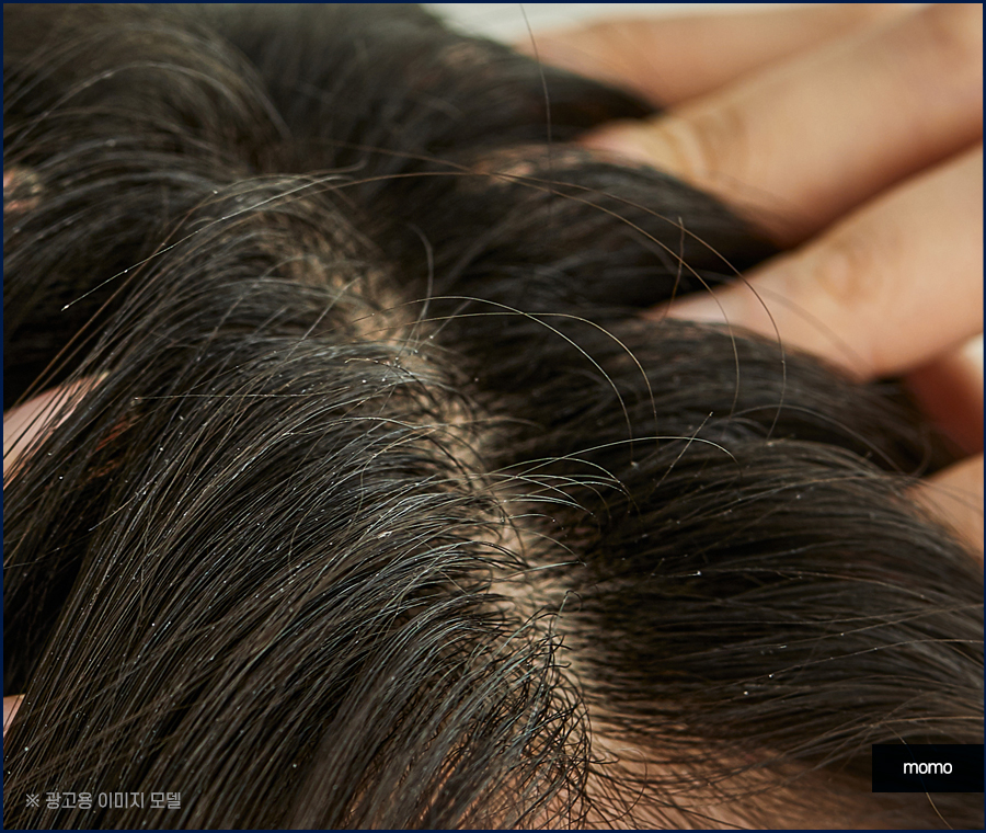 머리비듬없애는법 효과적인 비결에 대해 관련 이미지 5