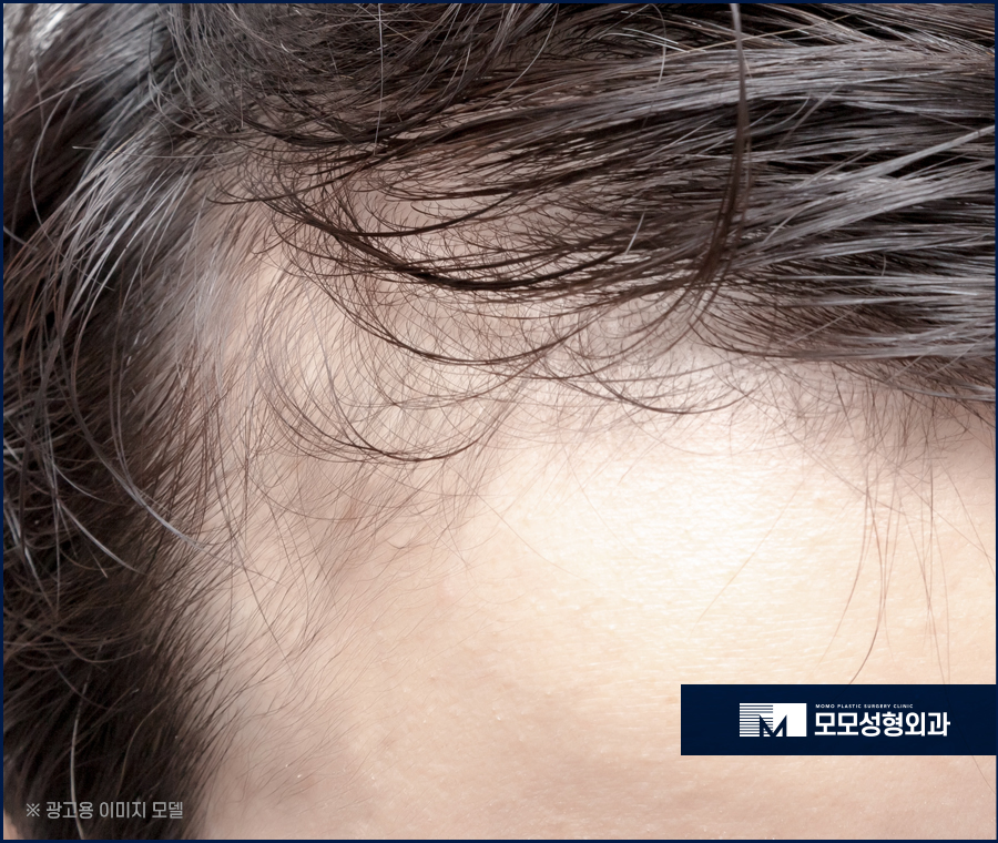 마이크로컷 비절개 모발이식 자연스러운 이후 외모를 관련 이미지 7