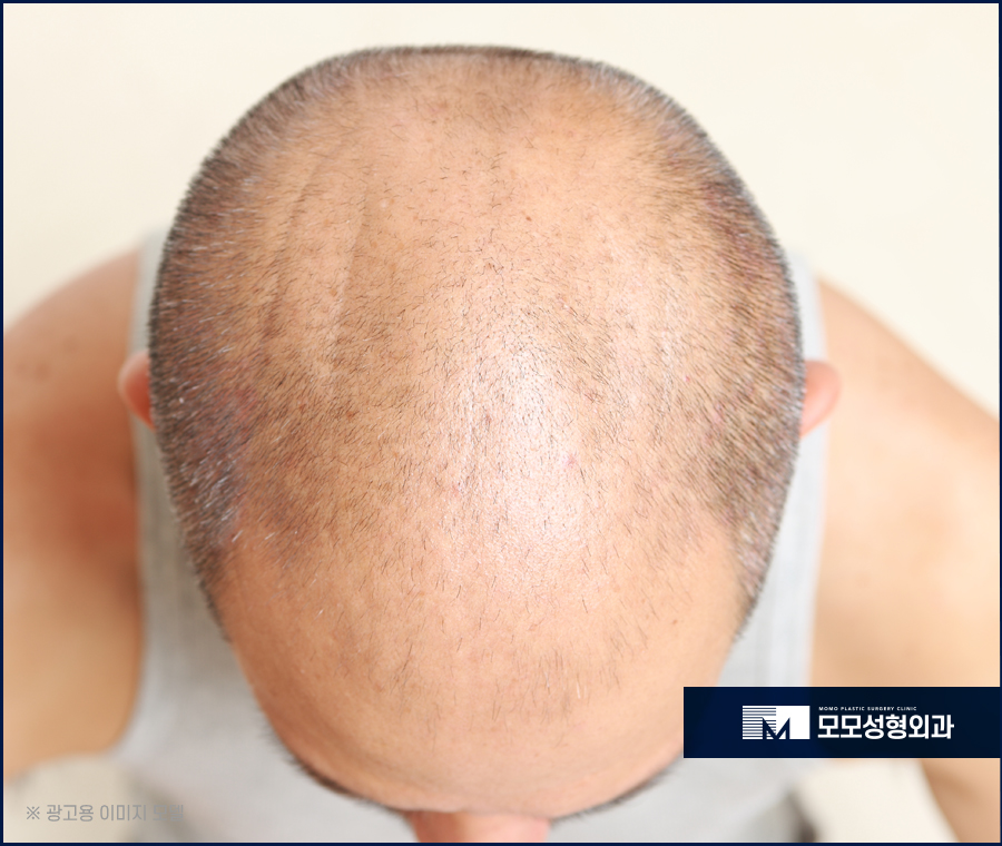모발이식회복기간 신속하게 이뤄지는 방향은 관련 이미지 3