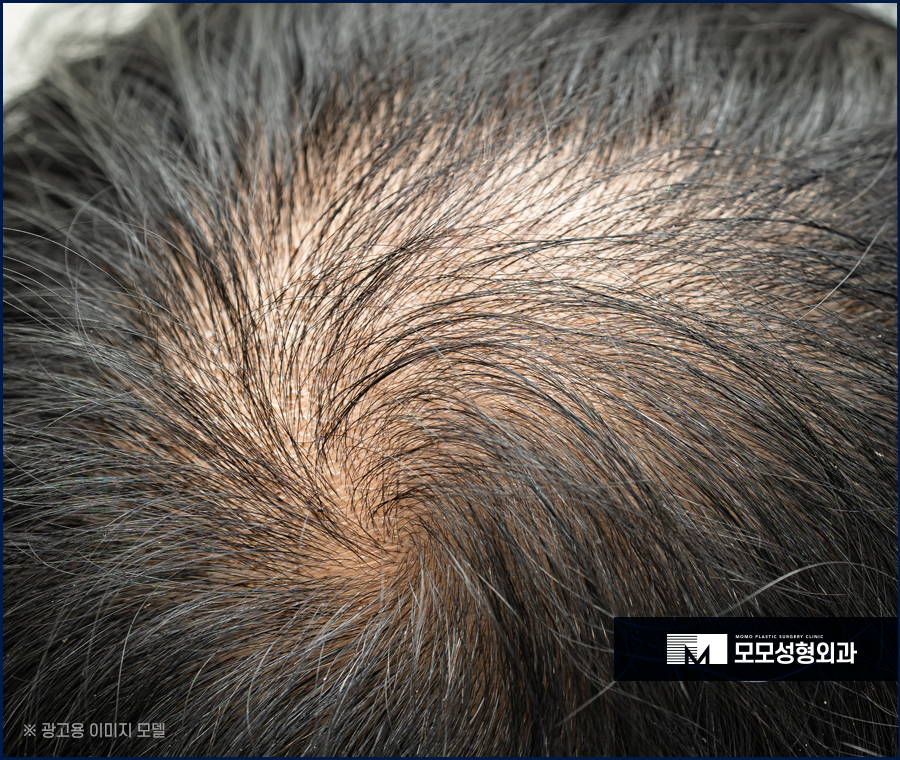 강남모발이식병원 탈모에 대한 고민을 나누는 곳 관련 이미지 3