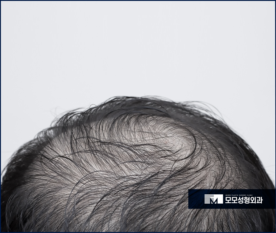 모발이식 후 모자 착용 방법과 주의사항에 대해 관련 이미지 2