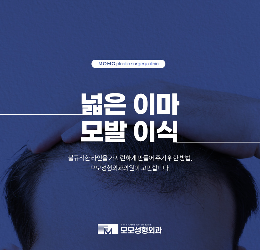 넓은이마모발이식 불규칙한 라인이 고민일 때에는 관련 이미지 1