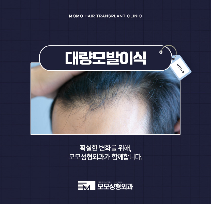 대량 모발이식 확연한 변화를 위해서 관련 이미지 1