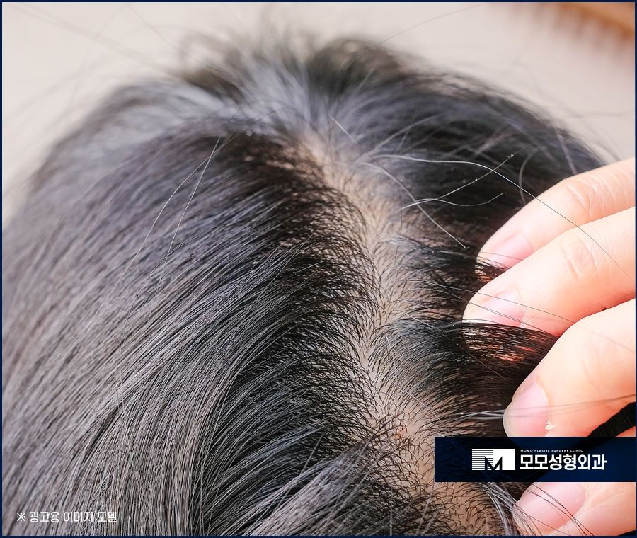 강남탈모치료 원인부터 알고 조치하도록 관련 이미지 7