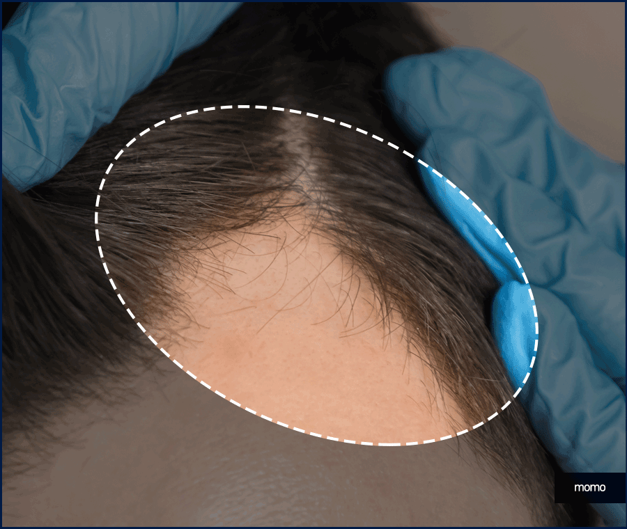 남자헤어라인모발이식 디자인의 중요성 관련 이미지 4