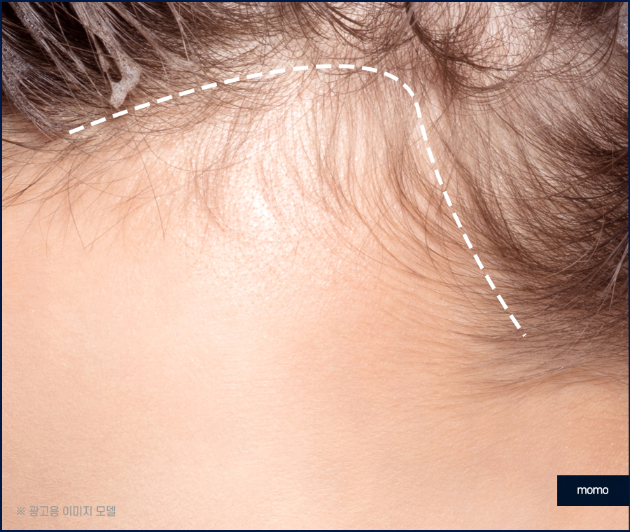 여자 헤어라인 모발이식 외모 자신감을 높이는 관련 이미지 9