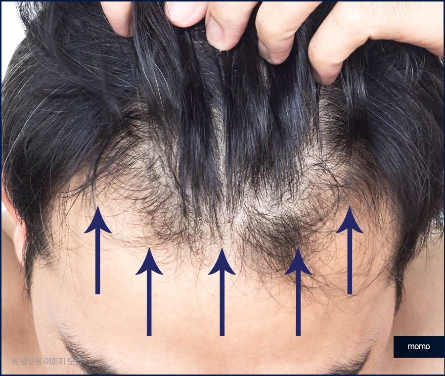 전두부탈모 원인과 시기, 해결 방안까지 관련 이미지 8