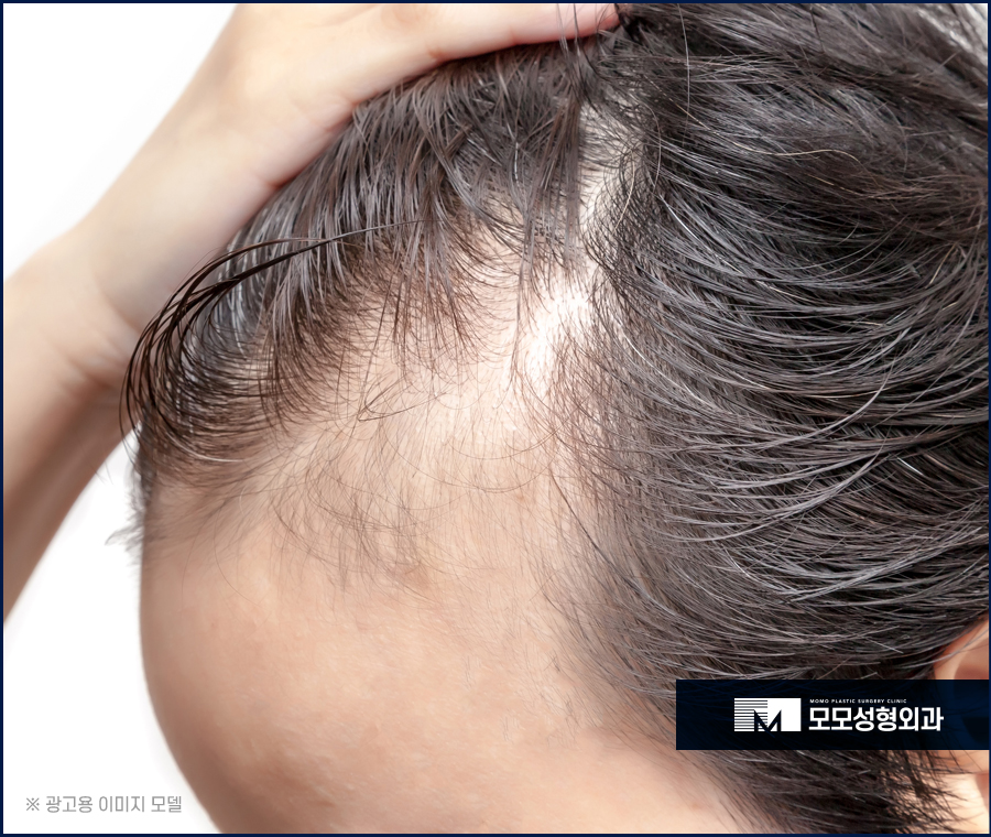 헤어라인 교정 비용 바라던 예후를 만들기 위한 관련 이미지 9