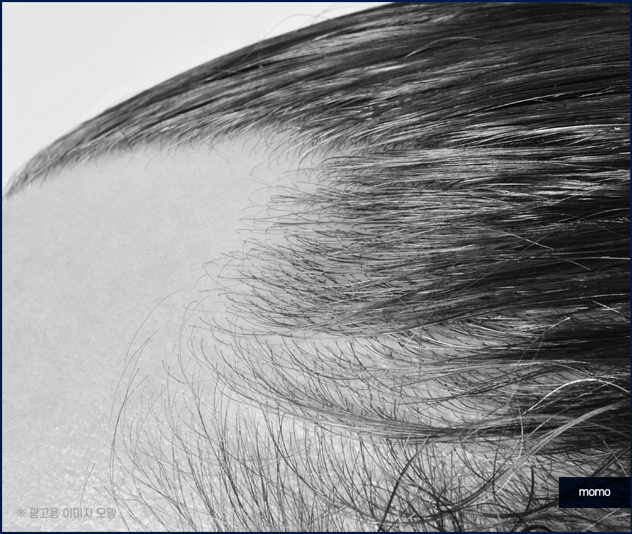 청소년 m자 탈모 요인 분석이 중요한 이유 관련 이미지 7