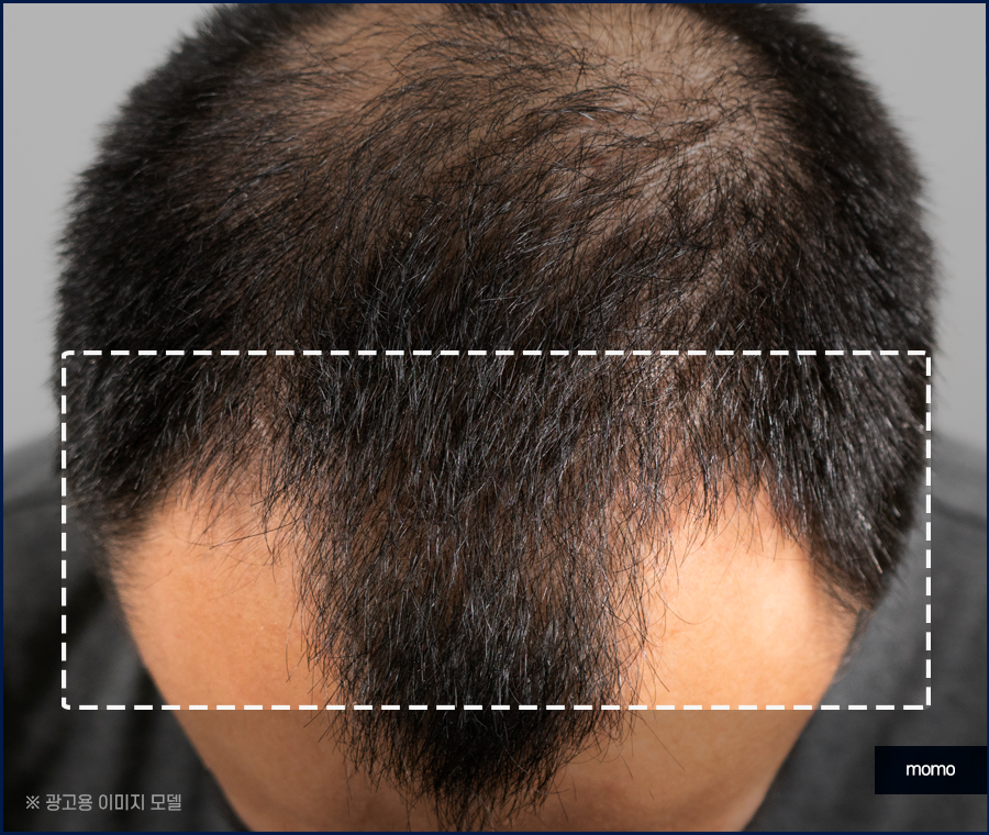 m자 모발이식 가격 달라지게 되는 이유는 관련 이미지 5