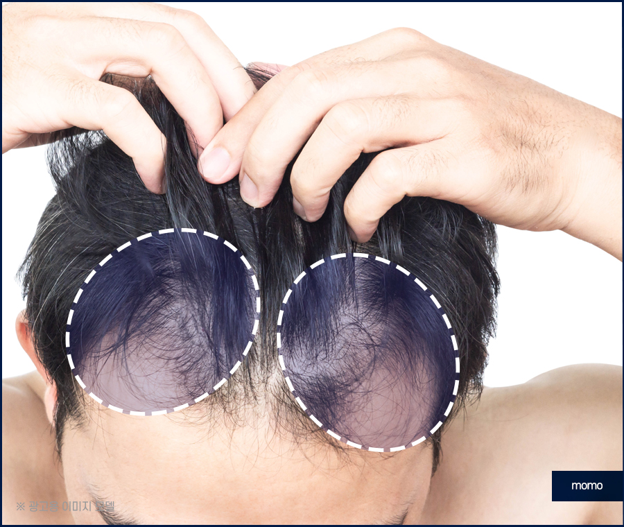 모발이식재수술 원인 파악을 먼저 관련 이미지 7
