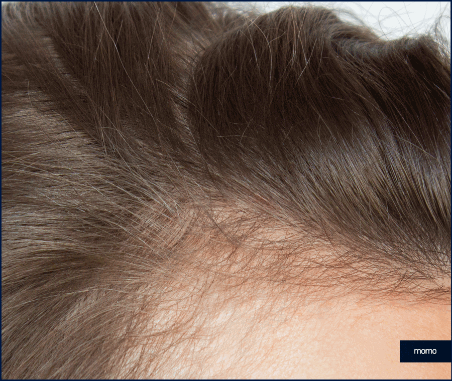 헤어라인 모발이식 비용보다 꼼꼼히 알아볼 조건은? 관련 이미지 9