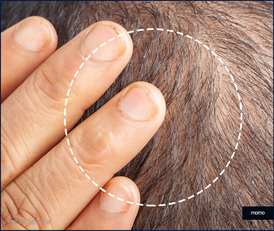 압구정 모발이식 건강한 두피를 만드는 방법 관련 이미지 9