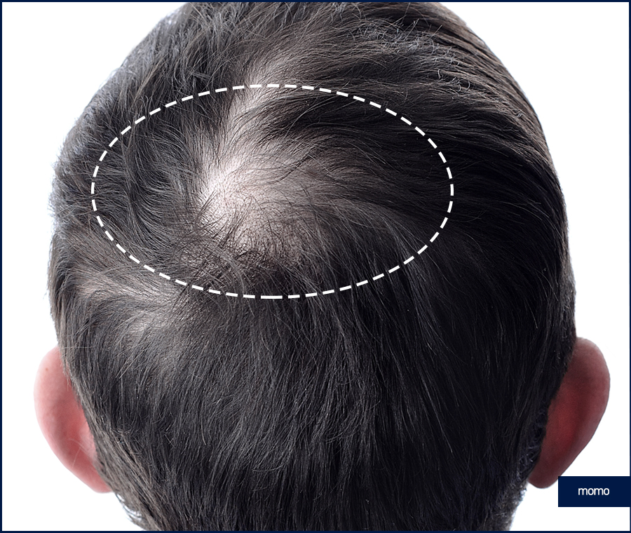 압구정역 모발이식 방법 및 생착률을 높이는 팁 관련 이미지 11