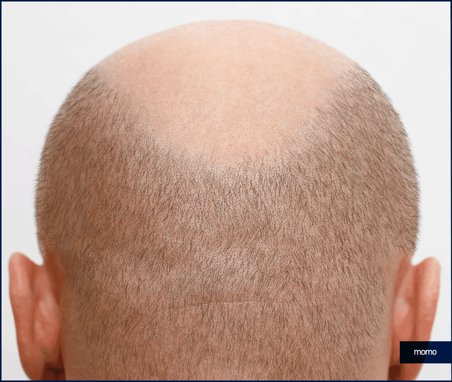 모발이식 생착기간 섬세한 관리가 필요한 이유 관련 이미지 6