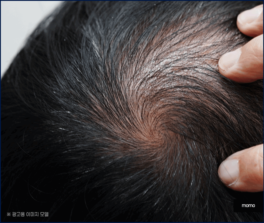 여자 정수리 탈모 초기 증상 및 머리카락빠짐 대응 방안 관련 이미지 9