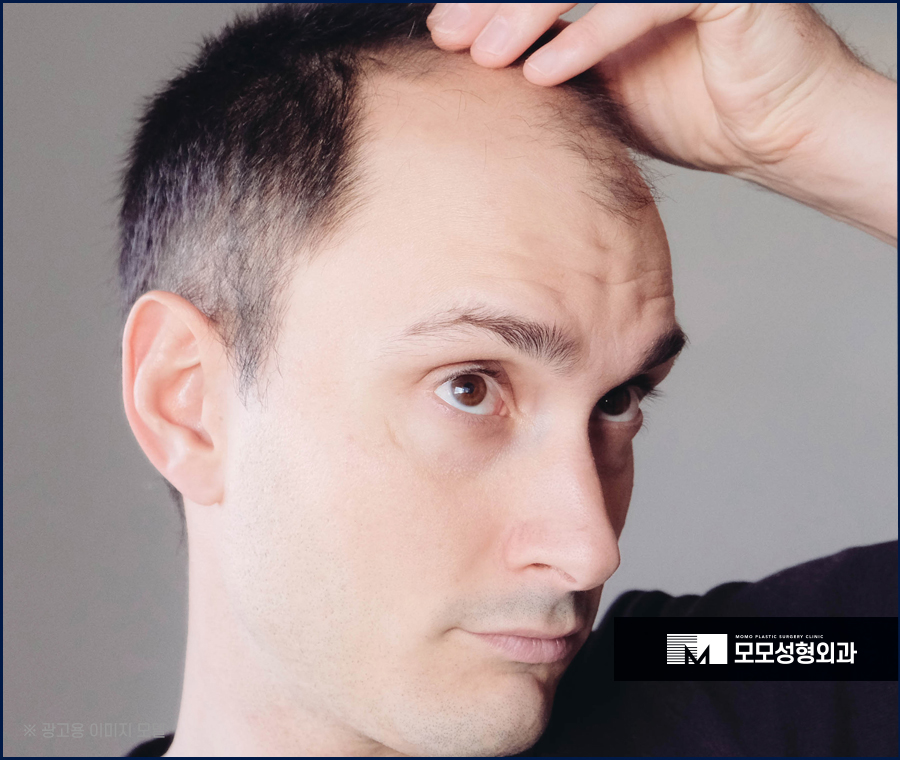 M자탈모병원 더 넓은 범위가 탈락하기 전에 관련 이미지 4