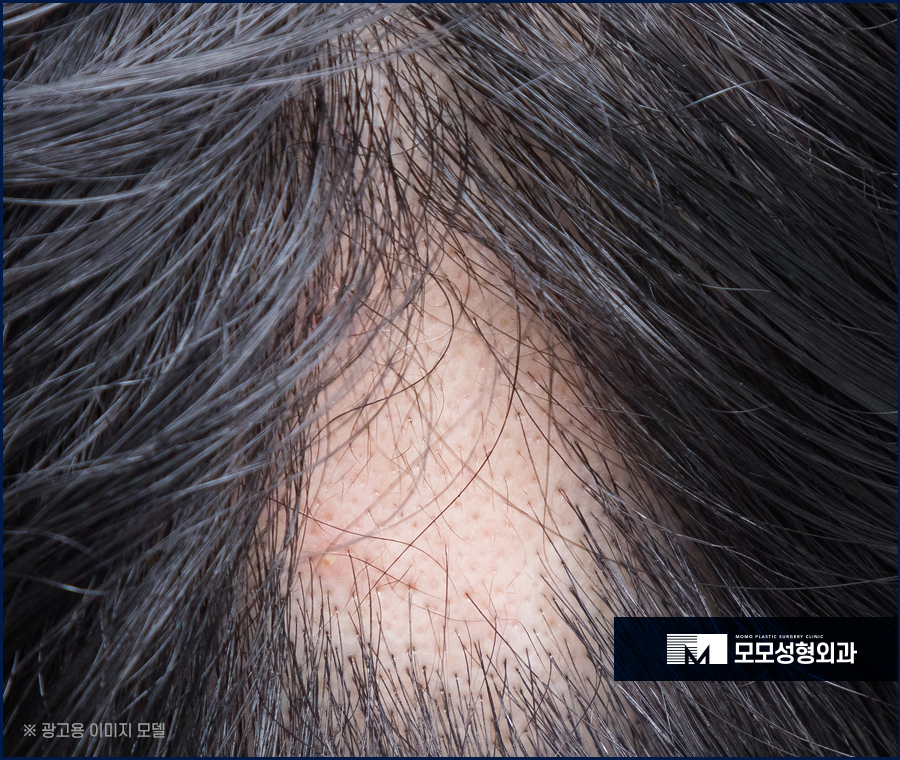 다발성원형탈모 원인부터 해결을 위한 방법 관련 이미지 3