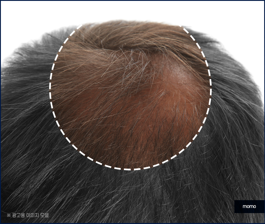 정수리 냄새 제거 원인부터 탁월한 제거 방안까지 관련 이미지 5