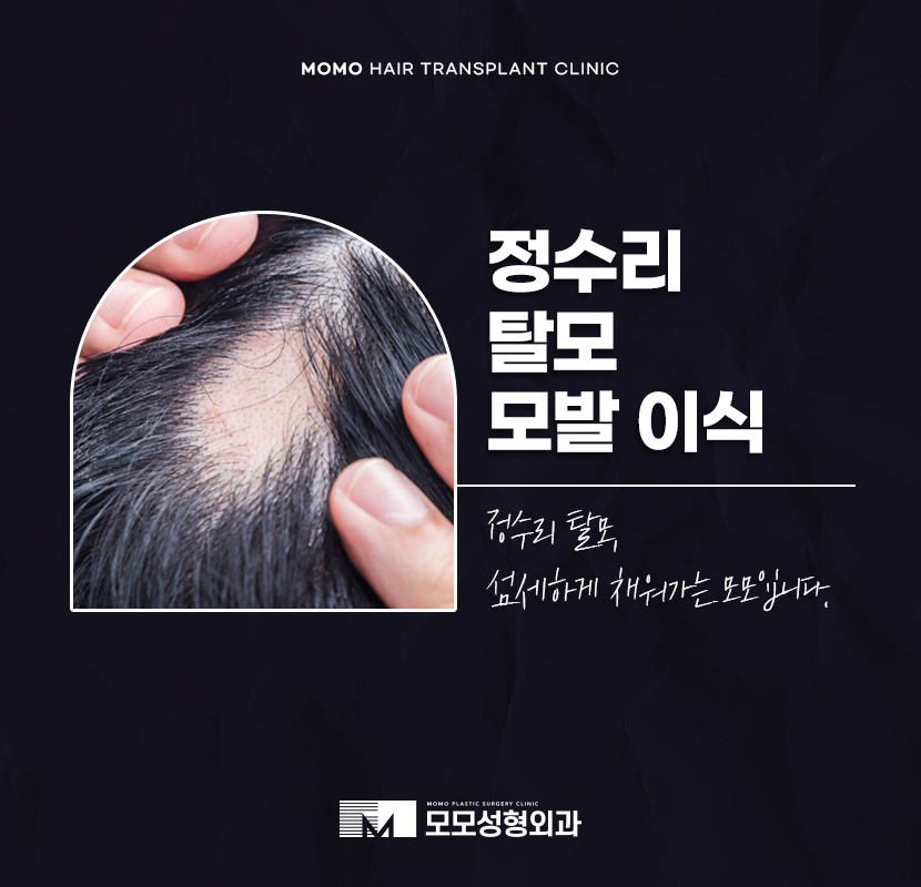정수리 탈모 모발이식 섬세하게 채워가는 관련 이미지 1