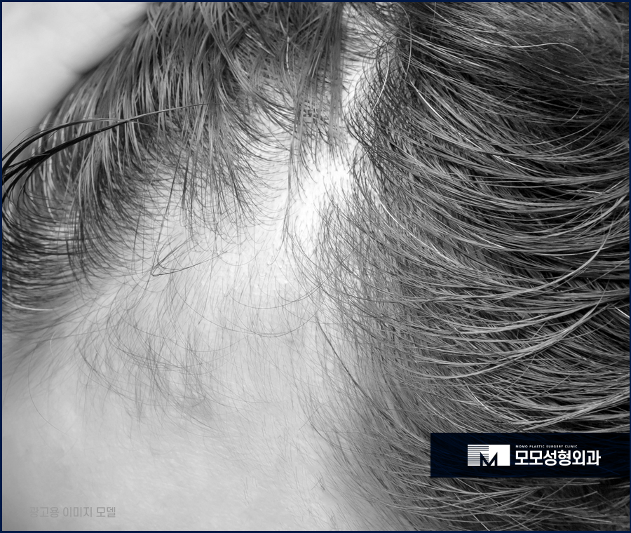 여자 헤어라인 모발이식 부작용 발생 우려를 낮춰야만 관련 이미지 3