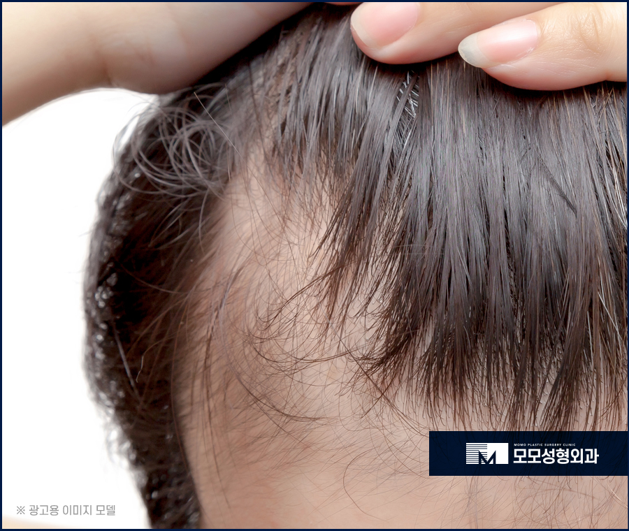 남자 앞머리 탈모 M자 라인 깊어짐이 보인다면 관련 이미지 2