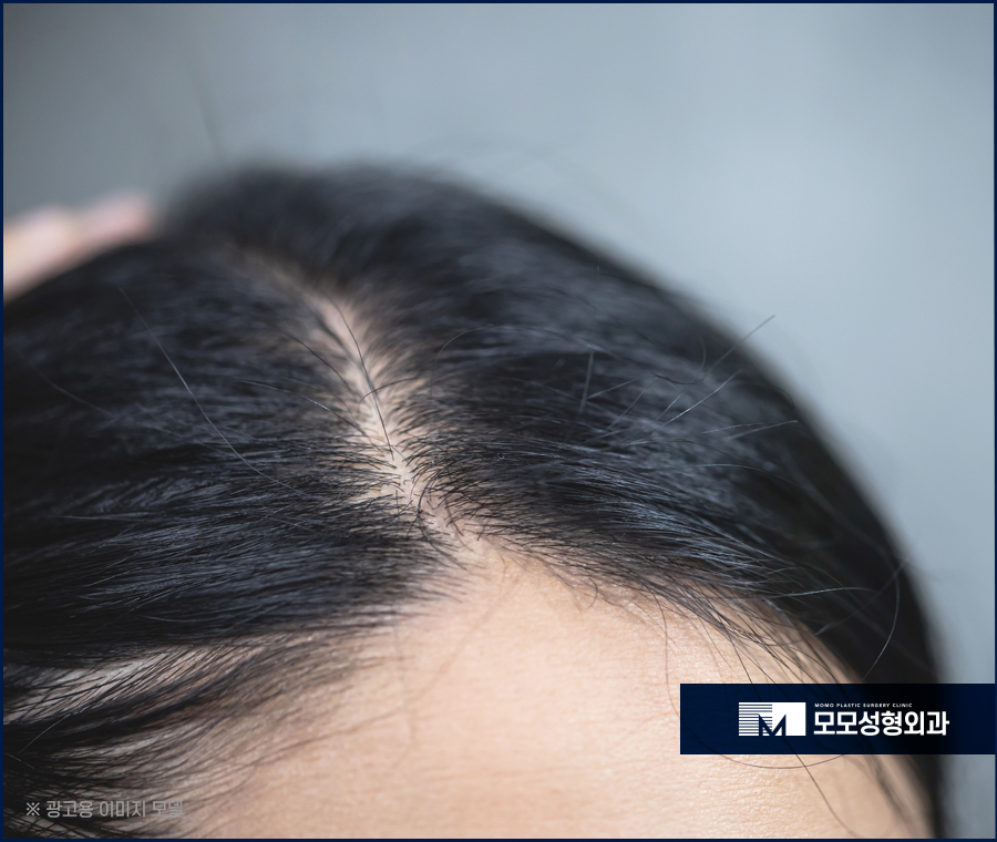 이마축소술 자연스럽게 채워가고 싶다면 관련 이미지 2