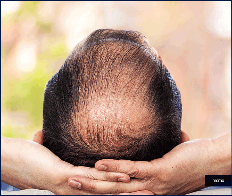 탈모약 처방 병원 꼼꼼한 진단하는 곳을 찾는다면 관련 이미지 4