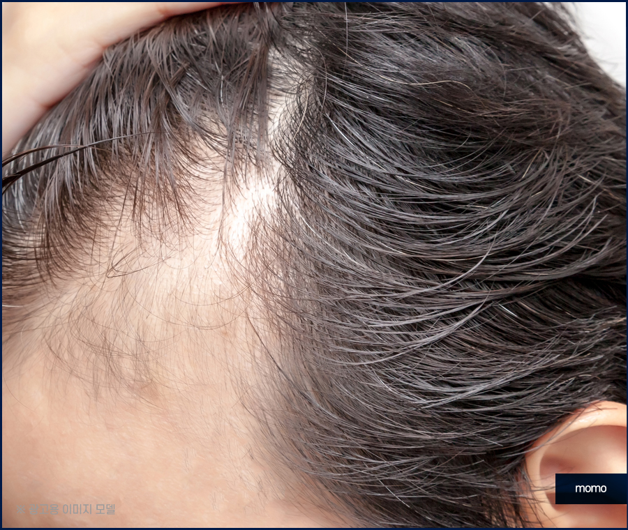 엠자이마 고민 탈출을 위한 모발이식 관련 이미지 5