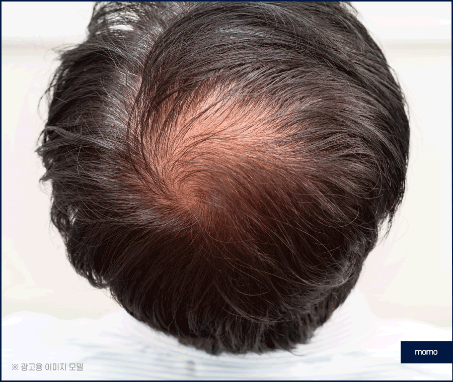 압구정모발이식 원하던 모습을 찾는 포인트 관련 이미지 9