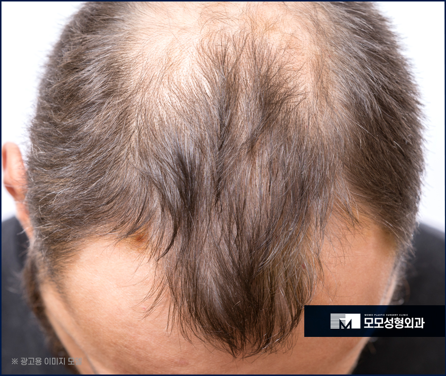 헤어라인교정후기 특성을 고려해서 관련 이미지 2