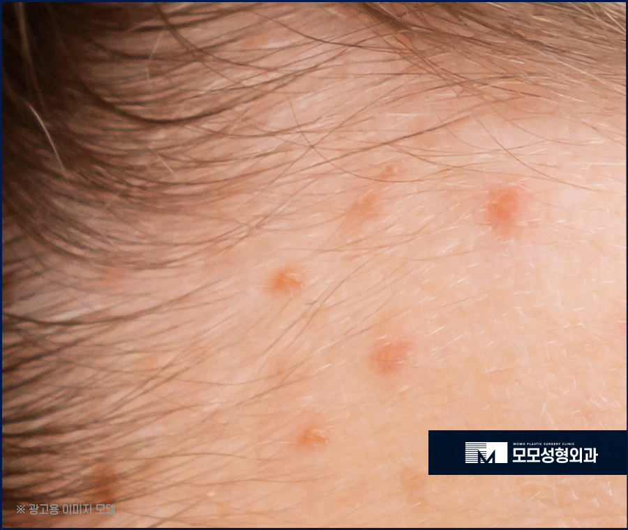 두피열내리기 방법과 중요한 이유까지 알아보는 관련 이미지 4