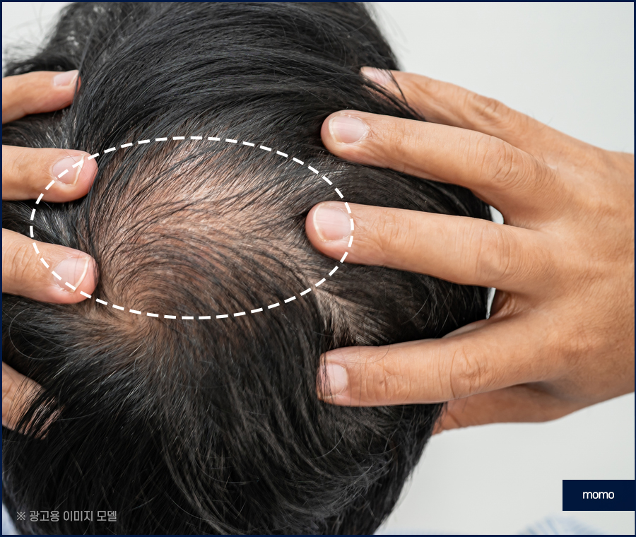강남 모발이식 정교하게 보완하는 관련 이미지 4