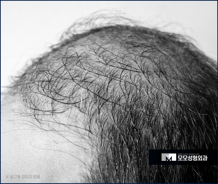 압구정모발이식 훌륭한 결과를 위해서는 관련 이미지 3