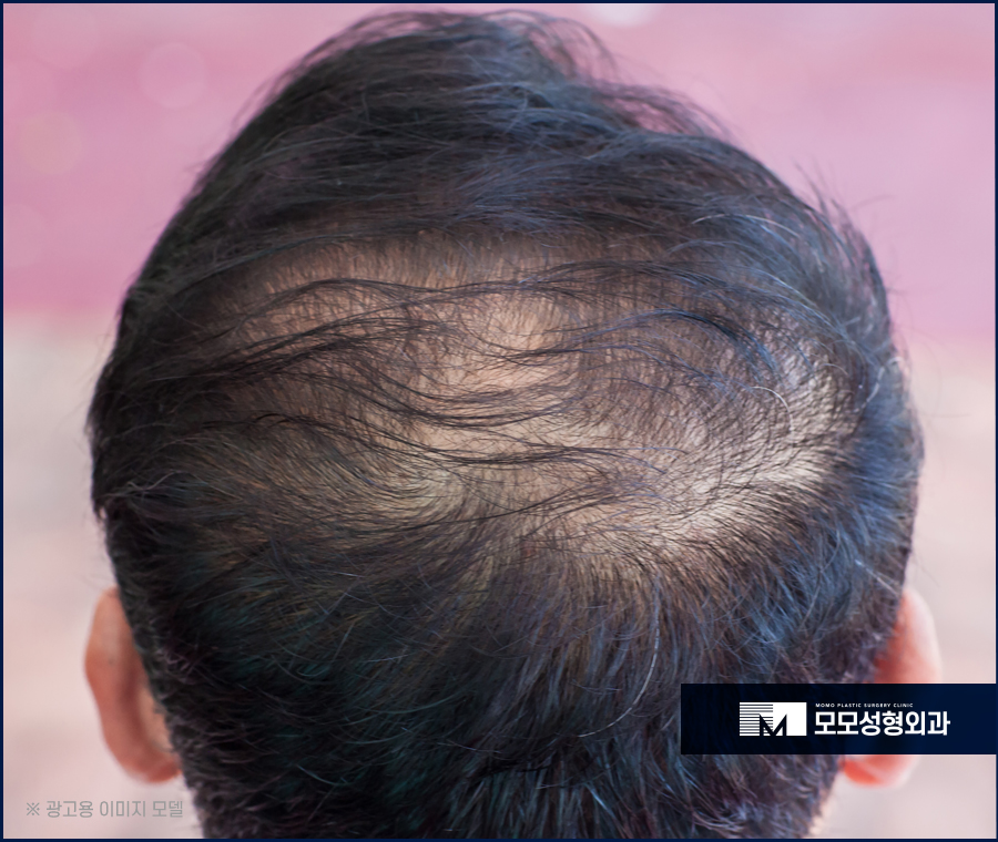 강남탈모병원 처치 방법에 대해 관련 이미지 2