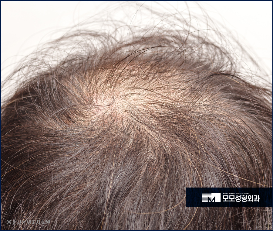 20대정수리탈모 찾아온 상황에서는 관련 이미지 6
