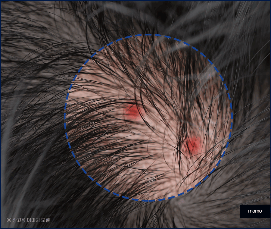 두피피딱지 원인 및 올바른 케어 방법은? 관련 이미지 5