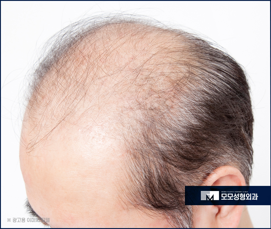 M자모발이식비용이 달라지는 기준과 방식의 차이에 대해 관련 이미지 11