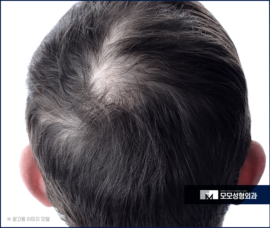 비절개모발이식 비용 넘쳐나는 자신감까지 만드는 관련 이미지 2