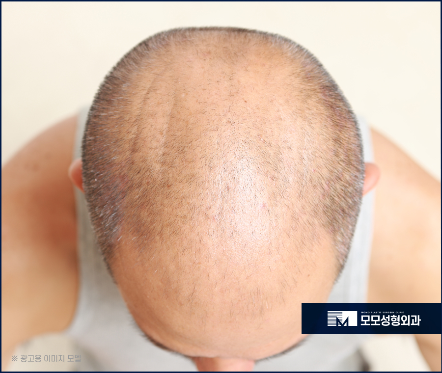 서울모발이식병원 전체적으로 자연스러운 관련 이미지 3