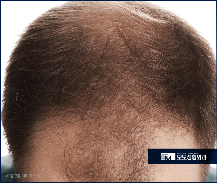 모발이식 후 흡연 기준과 주의해야 할 점에 대하여 관련 이미지 3