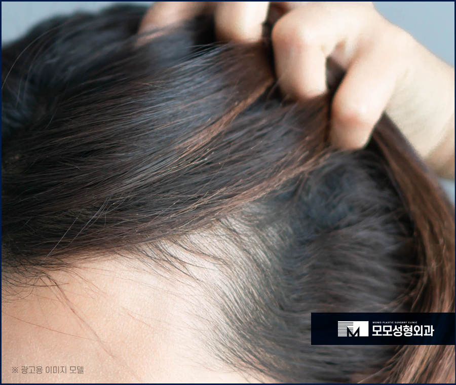 헤어라인 교정 비용 바라던 예후를 만들기 위한 관련 이미지 5
