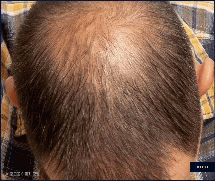 압구정 모발이식 병원 찾고 있다면 꼭 확인하세요 관련 이미지 10