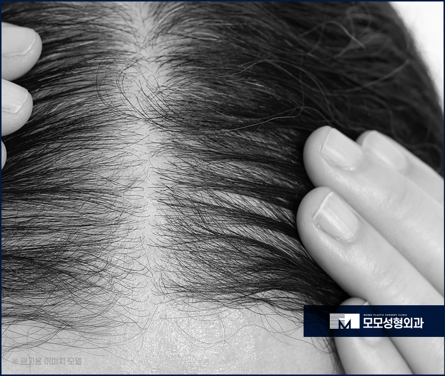 여자 옆머리 탈모 이유와 극복하고 채워가려면 관련 이미지 10