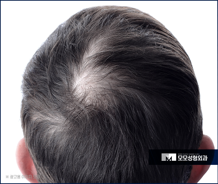 Male Hairline Hair Transplant: It Differs Depending on the Method image 6
