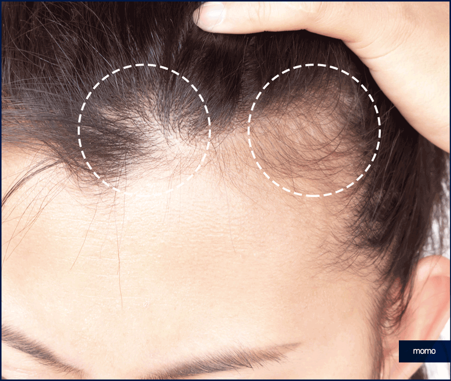앞머리 모발이식 비용 개인에 따라 달라지는 이유 관련 이미지 5