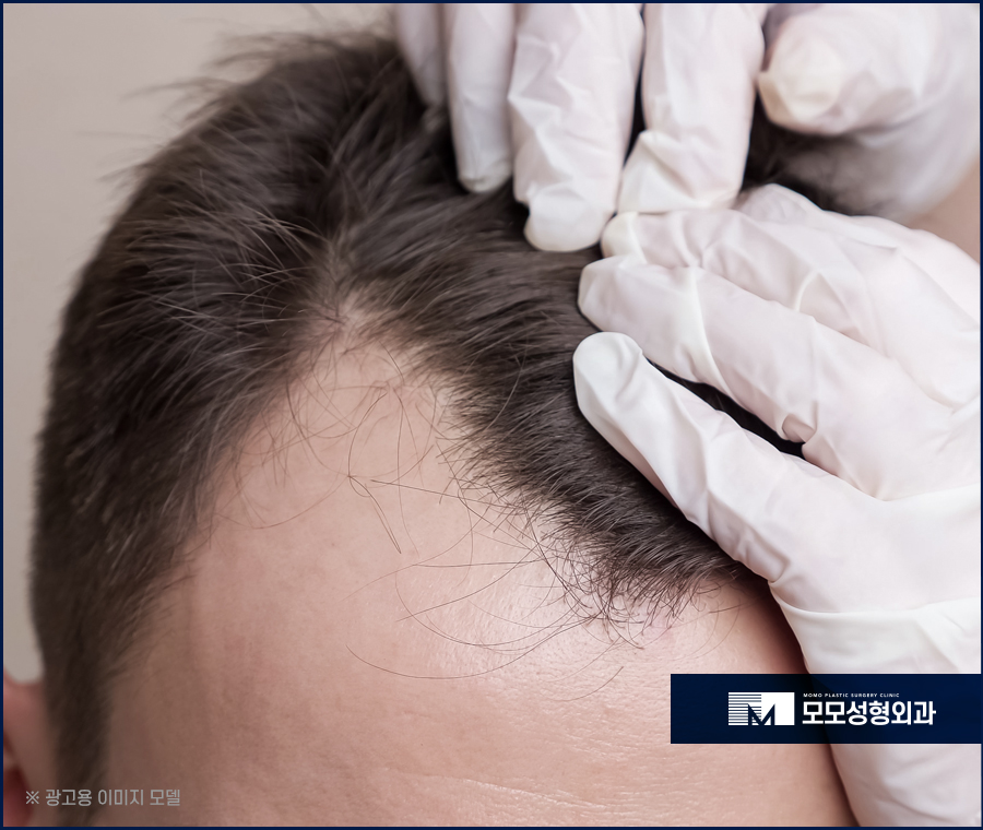 M자모발이식비용이 달라지는 기준과 방식의 차이에 대해 관련 이미지 12