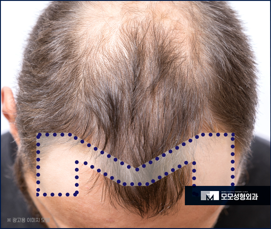 남자엠자탈모 극복을 위한 방향을 잘 잡아야만 관련 이미지 3