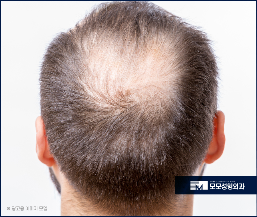 안드로겐성탈모 원인과 개선을 위한 방안은 관련 이미지 5